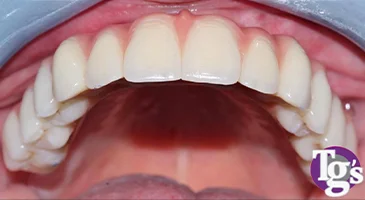 After treatment: a complete, even upper arch of replacement teeth