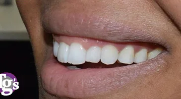 After composite bonding: the gap between the upper front teeth closed