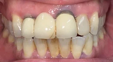 Before treatment: a discoloured, darkened upper front tooth among natural teeth