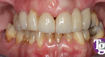 After treatment: evenly shaped, uniform upper front teeth