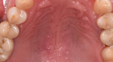 After treatment: occlusal view of the upper arch with the implants restored and no visible gaps