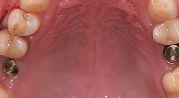Before treatment: occlusal view of the upper arch with two exposed implant posts and no crowns fitted