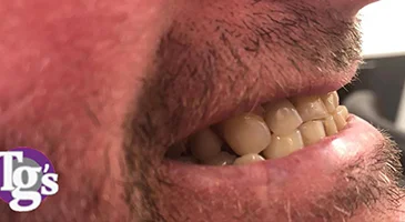 After treatment: a full, even set of teeth filling the arch