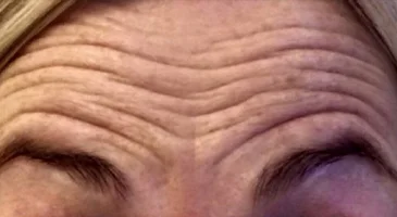 Before treatment: deep lines across the forehead