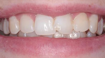 Before Invisalign: crowded, overlapping front teeth