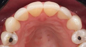 After Invisalign: occlusal view of the upper arch showing a more even, aligned arch