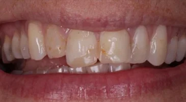 Before porcelain veneers: worn, chipped and discoloured upper front teeth